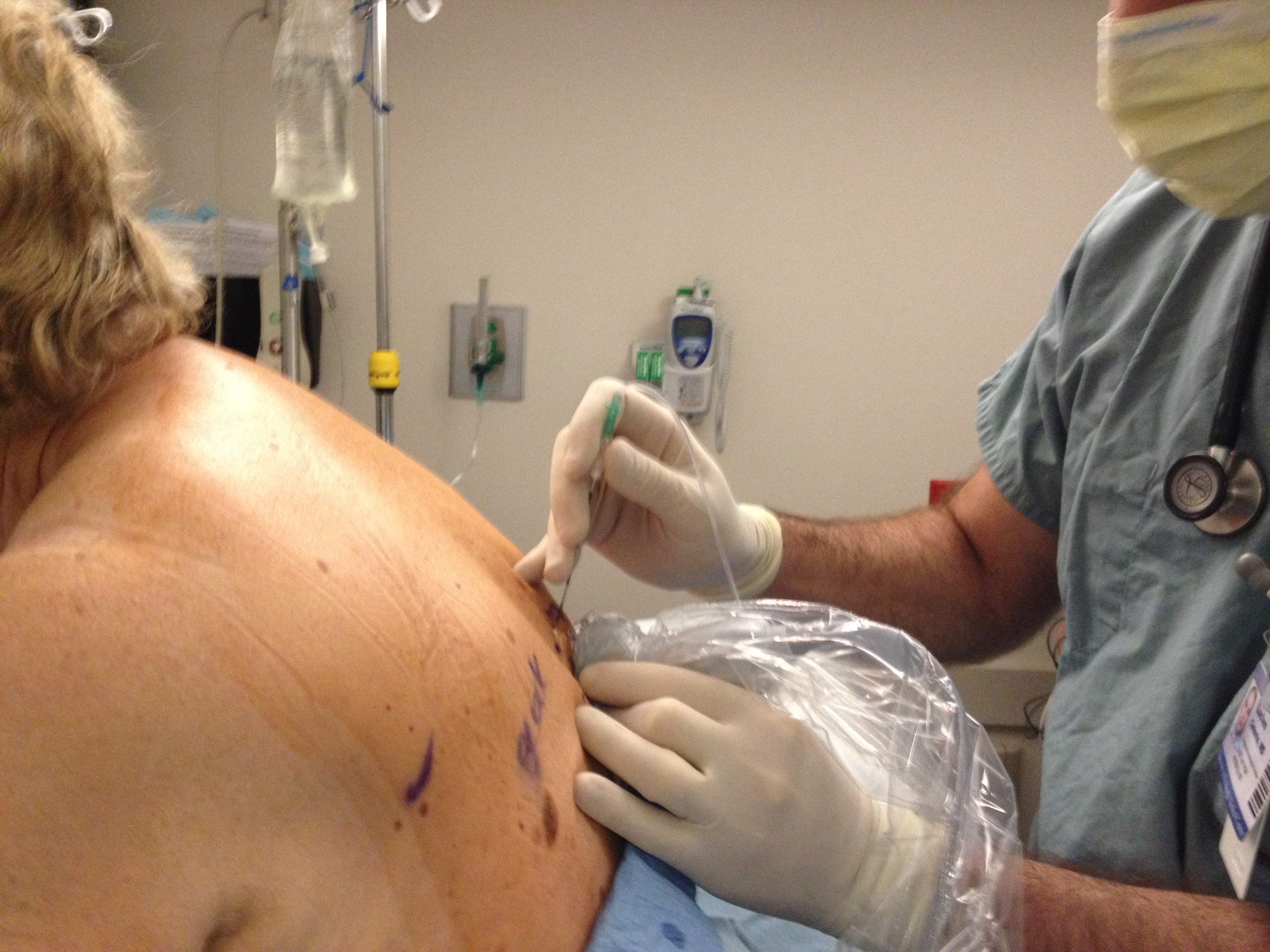 Positioning of the ultrasound probe and the needle with in-plane parasagittal approach
