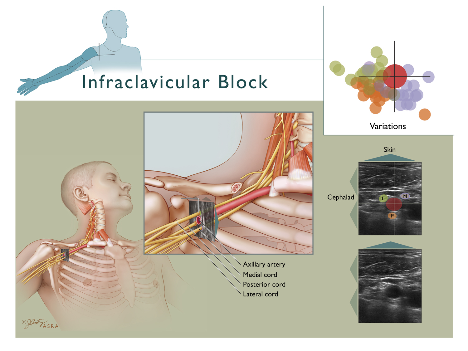 Infraclavicular Block_UL503