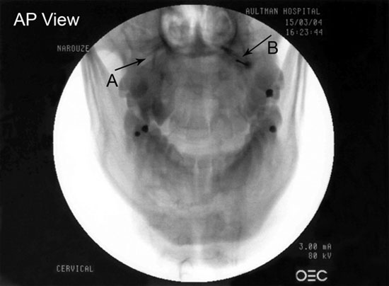 cervicogenic-headache-lateral-atlanto-axial-joint