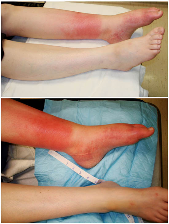 complex-regional-pain-syndrome-equinovarus-left-foot