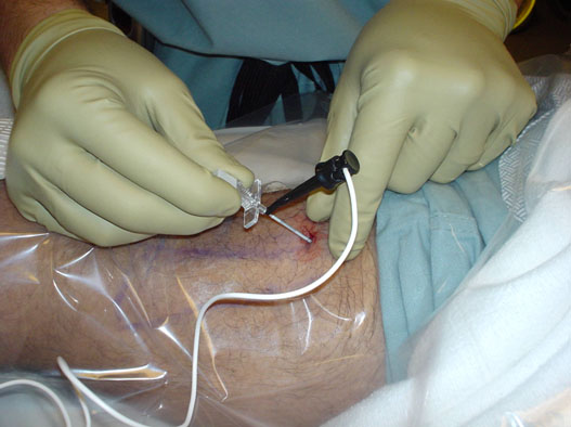 continuous-peripheral-nerve-blocks-cpnb-placement-needle