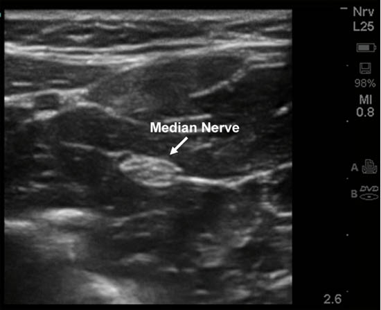 distal-peripheral-nerve-blocks-blockade-in-the-forearm
