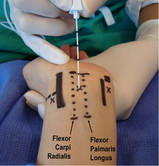 distal-peripheral-nerve-blocks-median-nerve-blockade