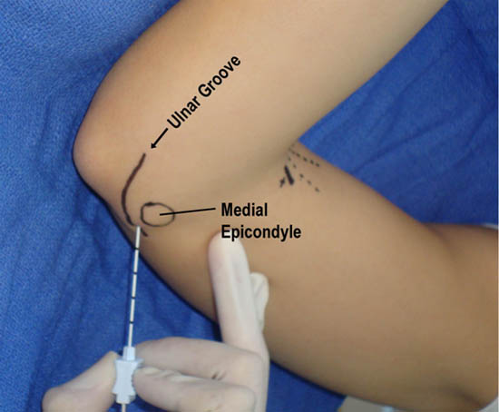 distal-peripheral-nerve-blocks-ulnar-nerve-blockade-elbow