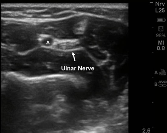 distal-peripheral-nerve-blocks-ulnar-nerve-blockade-forearm