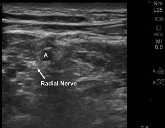 distal-peripheral-nerve-blocks-ultrasound-guided-radial