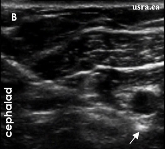 Sonogram showing needle tip posterior to the axillary artery.