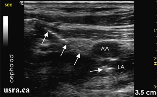 Sonoanatomy of the infraclavicular region showing needle advancement using an in plane lateral approach