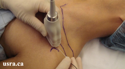 In-plane needle technique for the vertical infraclavicular approach
