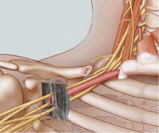 Ultrasound visualization of the brachial plexus cords in the infraclavicular region.