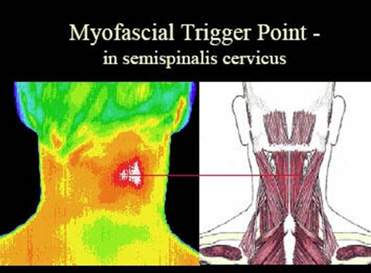 myofascial-pain-thermogram-of-myofascial-trigger-point