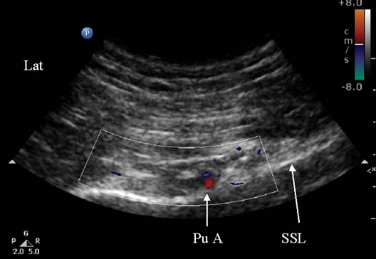 pudendal-nerve-injection-color-doppler-showing-the-pudendal-artery