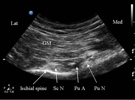 pudendal-nerve-injection-sonogram-showing-underlying-structures