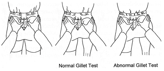sacroiliac-joint-pain-gillets-test