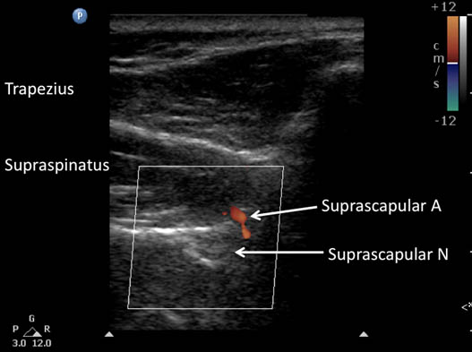 suprascapular-nerve-block-suprascapular-nerve-slightly-posterior