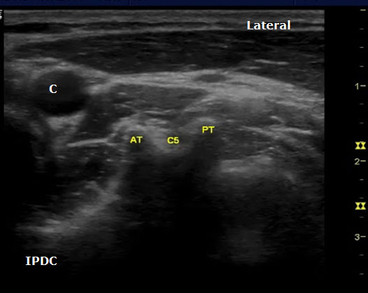 ultrasound-guided-axial-blocks-c5-level