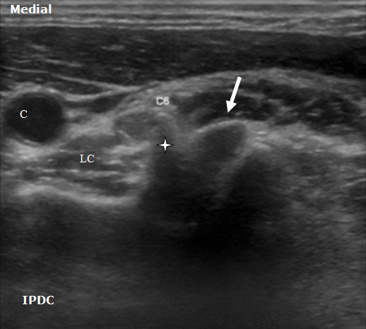 ultrasound-guided-axial-blocks-c6-vertebral-level