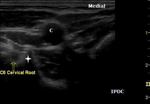 ultrasound-guided-axial-blocks-nerve-root-and-the-prominent-anterior-tube