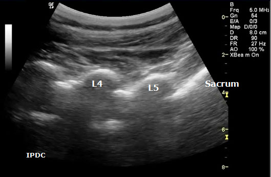 ultrasound-guided-axial-blocks-paramedian-oblique-longitudinal-sonogram