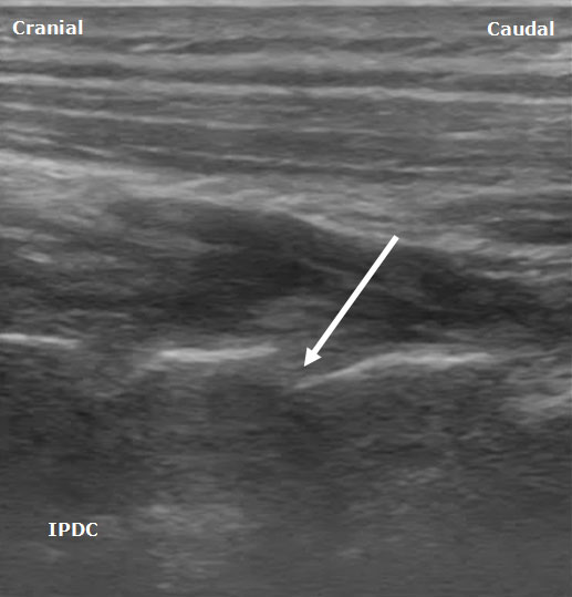 ultrasound-guided-axial-blocks-posterior-sagittal-ultrasound-image