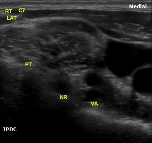 ultrasound-guided-axial-blocks-right-c7-vertebral-level