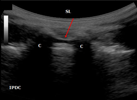 ultrasound-guided-axial-blocks-sacral-hiatus-between-the-sacral-cornuae