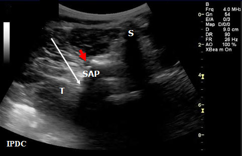 ultrasound-guided-axial-blocks-sonographicccross-axis-view