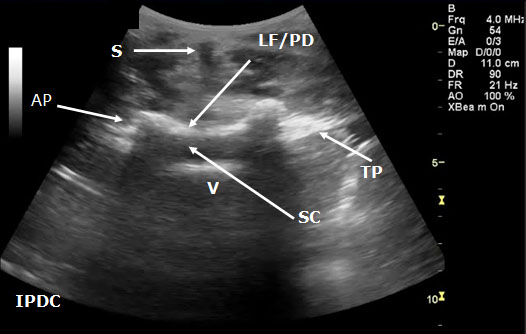 ultrasound-guided-axial-blocks-transverse-sonogram-of-the-lumbar-interspa
