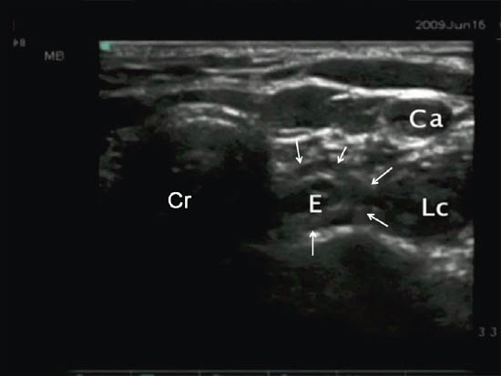 ultrasound-guided-block-for-peripheral-structures-deviation-of-esophagus