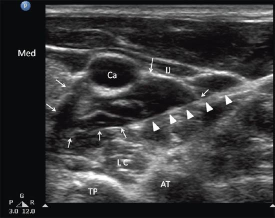 ultrasound-guided-block-for-peripheral-structures-following-injection-of-local-an