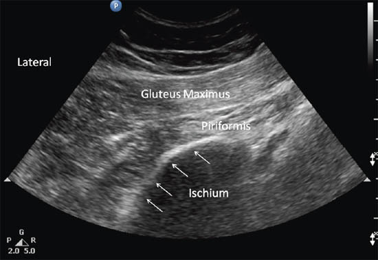 ultrasound-guided-block-for-peripheral-structures-piriformis-muscle-and-surroundi