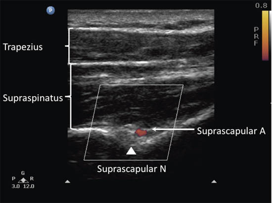 ultrasound-guided-block-for-peripheral-structures-suprascapular-nerve
