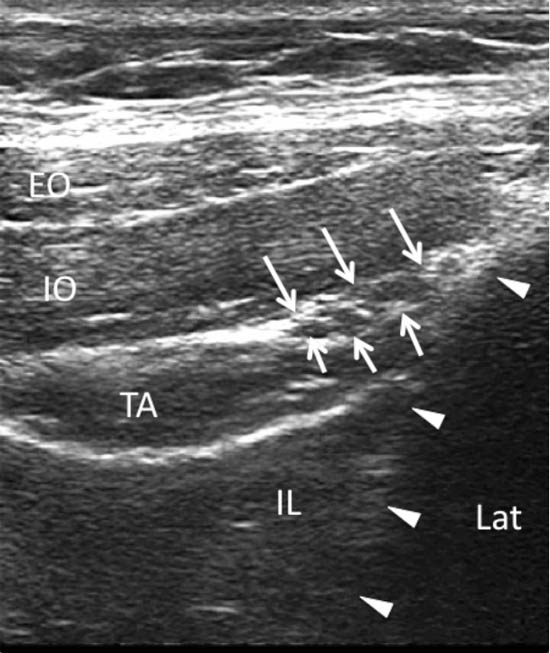 ultrasound-guided-block-for-peripheral-structures-three-layers-of-abdominal-muscl