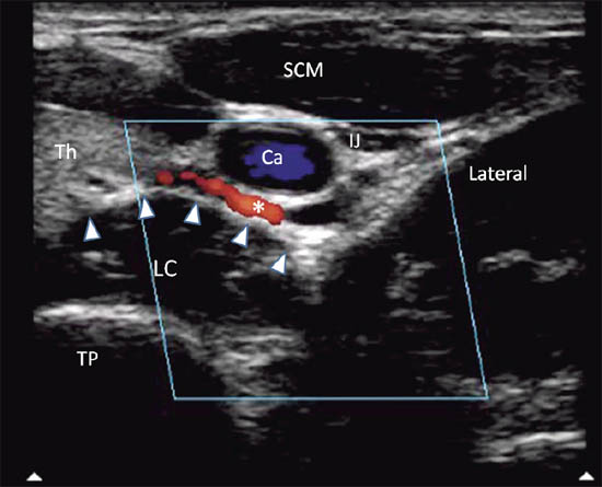 ultrasound-guided-block-for-peripheral-structures-ultrasonographic-image-with-col