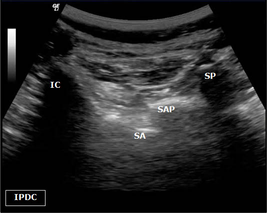 ultrasound-guided-lumbar-medial-branch-block-l5-dorsal-ramus