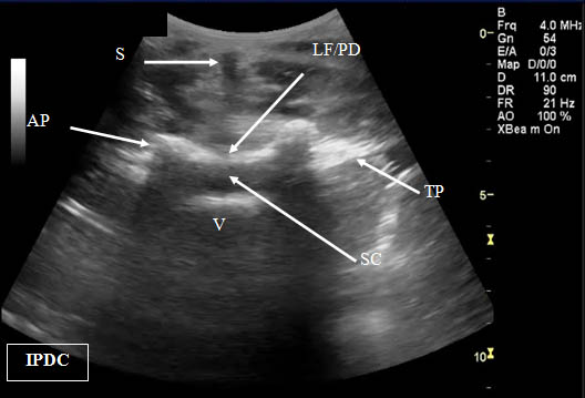 ultrasound-guided-lumbar-medial-branch-block-lumbar-interspace