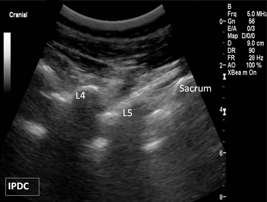 ultrasound-guided-lumbar-medial-branch-block-paramedian-oblique-sagittal-sonogram
