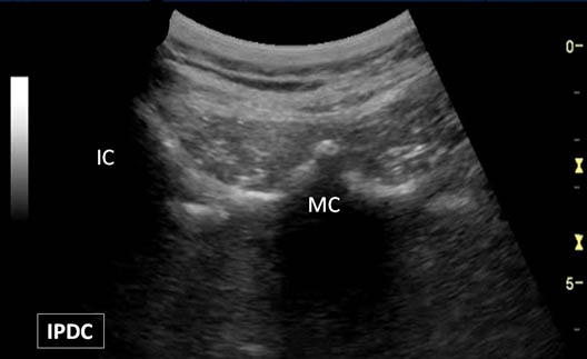 ultrasound-guided-lumbar-medial-branch-block-s1-median-crest