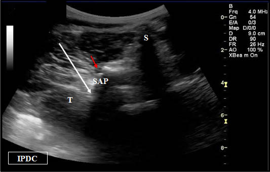ultrasound-guided-lumbar-medial-branch-block-spinous-transverse-and-superior-artic