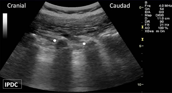 ultrasound-guided-lumbar-medial-branch-block-transverse-processes
