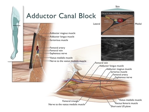 Adductor Canal Block