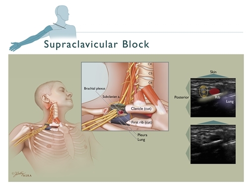 Supraclavicular Block