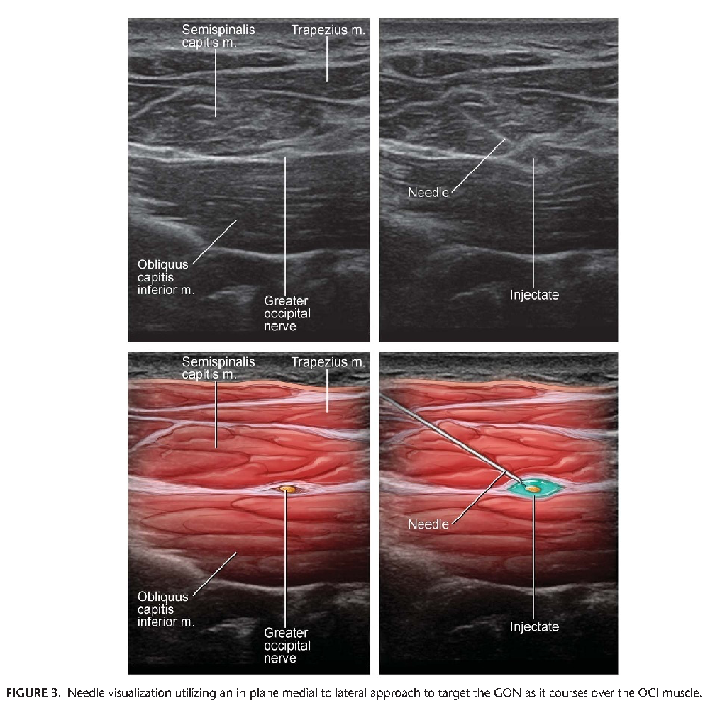 Needle visualization utilizing an in-plane medial to lateral approach to target the GON as it courses over the OCI muscle