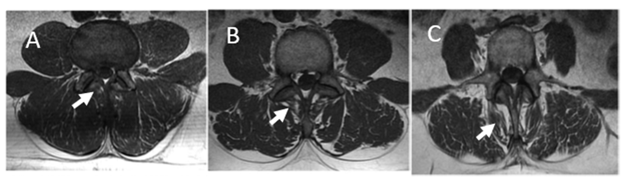 T1-weighted magnetic resonance images of lumbar spine at L3 