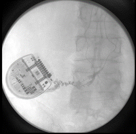 X-ray showing partial dislodgement
