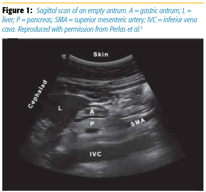 Figure 1. Sagittal scan of an empty antrum