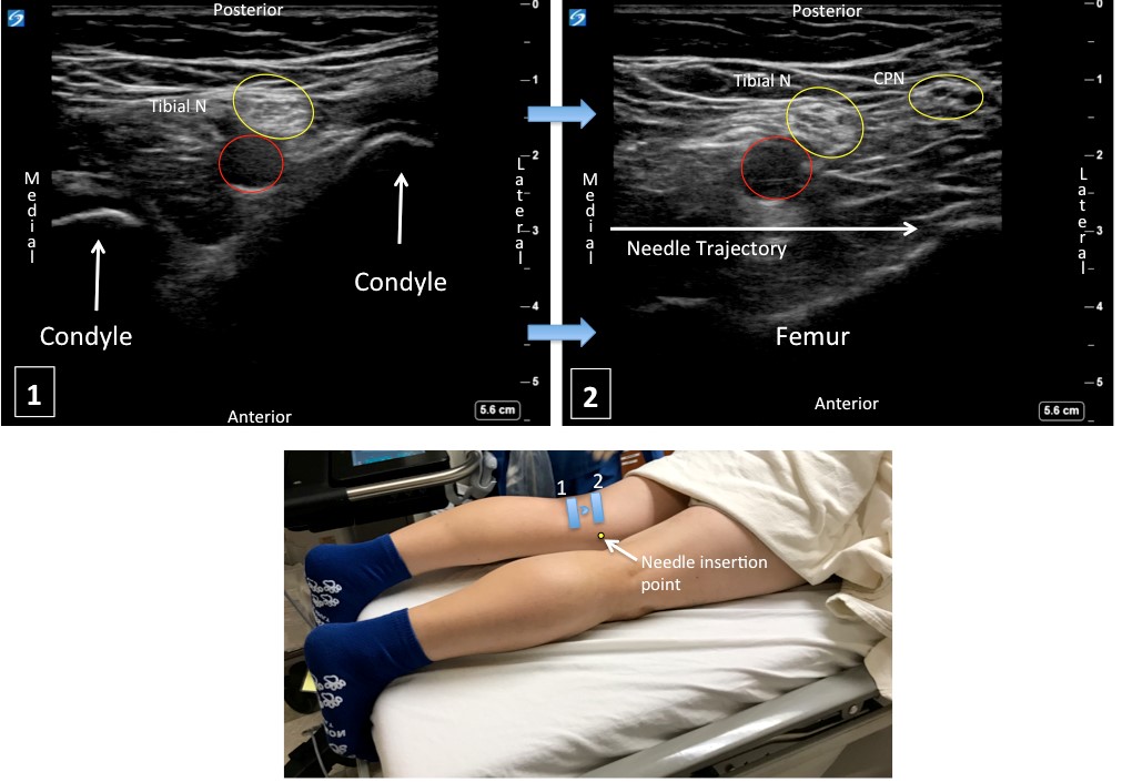 Scanning Sequence of Popliteal Fossa for iPACK With Corresponding Sonograms