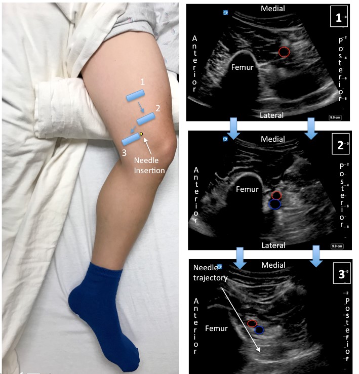 Scanning Sequence for iPACK Using the Posteromedial Acoustic Window With Corresponding Sonograms