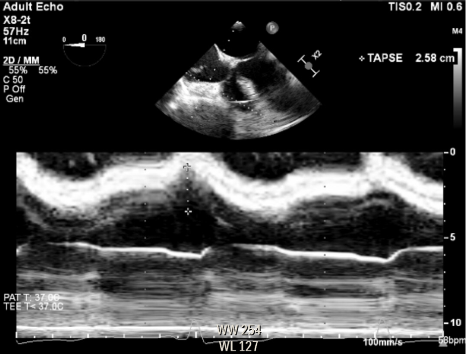 POCUS Spotlight: Resuscitative Perioperative Transesophageal ...