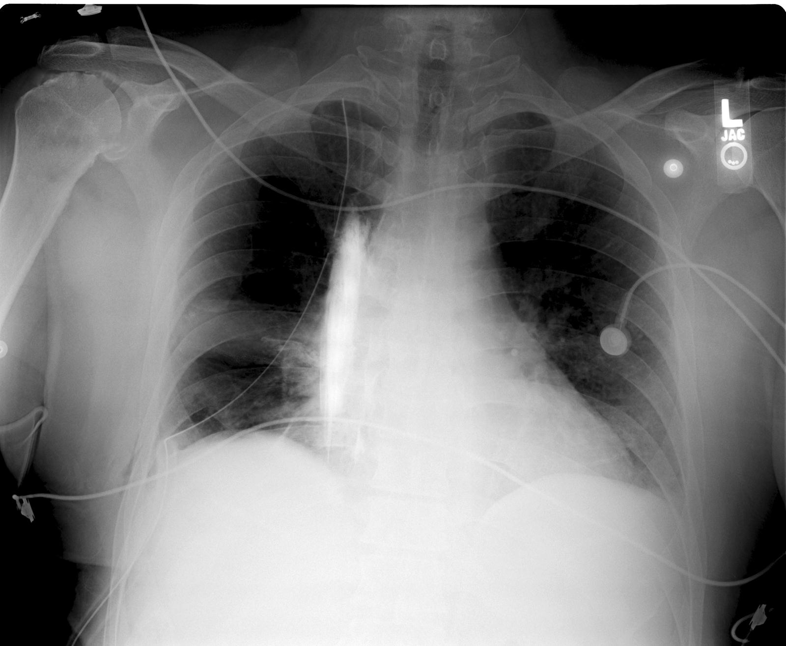 X-Ray of the thoracic paravertebral space